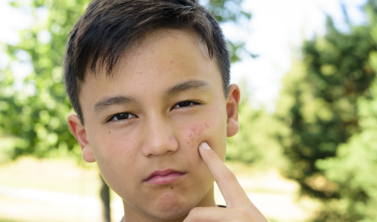 Dậy thì muộn - Hình ảnh minh họa